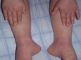 Ayaklarda Dolaşım Bozukluğu Belirtileri ve Tedavisi